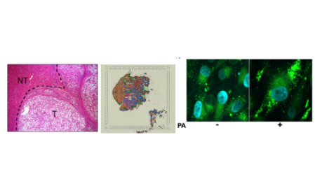在肝細胞癌中多組學確定了瘤內脂肪變性和耗竭腫瘤免疫微環境之間的聯系